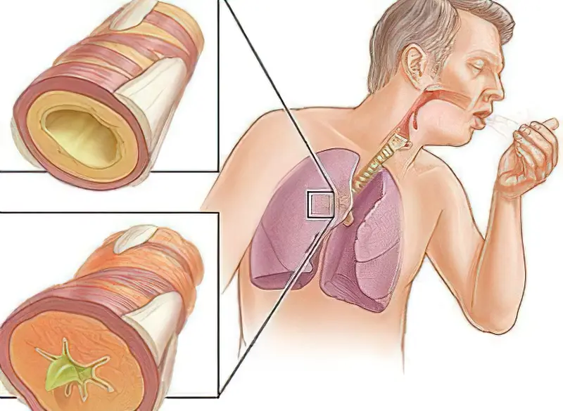 Бронхіальна астма: симптоми, діагностика, лікування та профілактика 1
