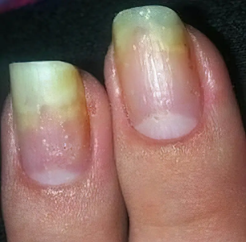 Грибок нігтів на руках: фото початкової стадії, лікування 2