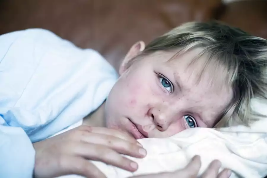 Кір у дітей: симптоми, лікування та профілактика 1