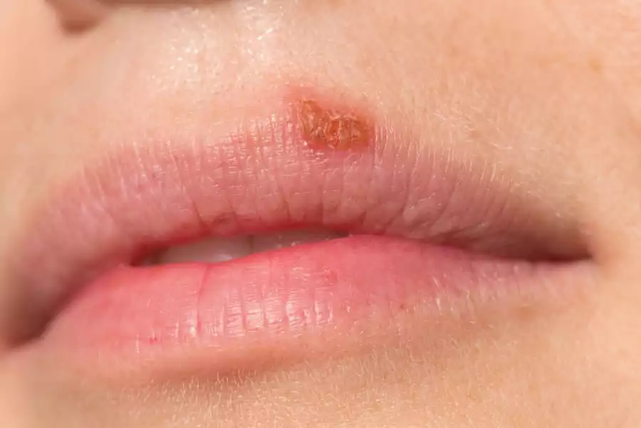 Герпес на губах: симптоми, лікування та профілактика 16