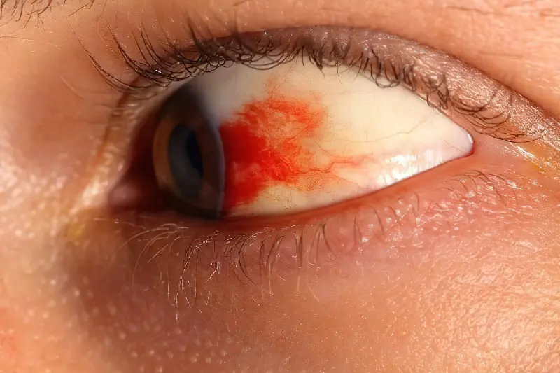 Крововилив в око: причини, симптоми та лікування 14