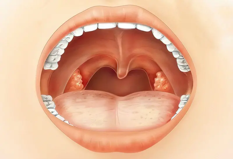 Пробки в горлі: причини, симптоми та методи лікування 9
