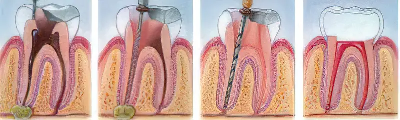 Лікування гранулеми зуба: методи та ефективність 2