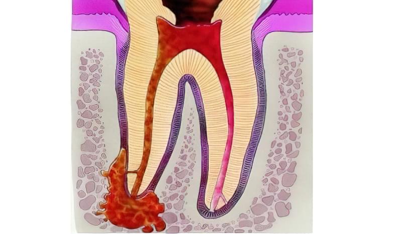 Лікування гранулеми зуба: методи та ефективність 4