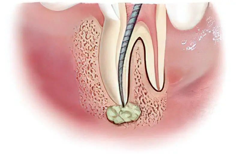 Лікування гранулеми зуба: методи та ефективність 3