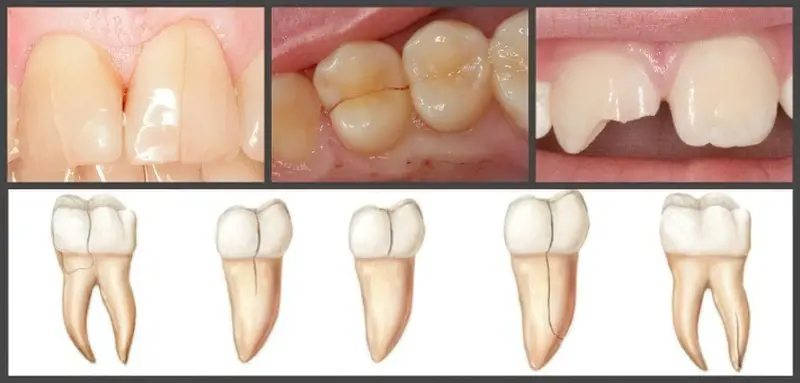 Тріщини на зубах: причини та симптоми 12