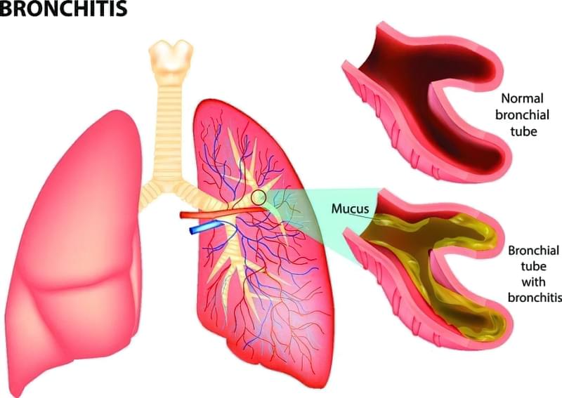 Бронхообструкція: як розпізнати і лікувати 27