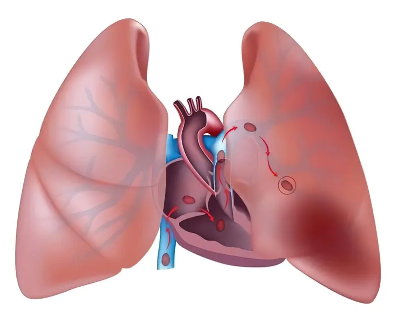 Інфаркт легені: симптоми і лікування 4