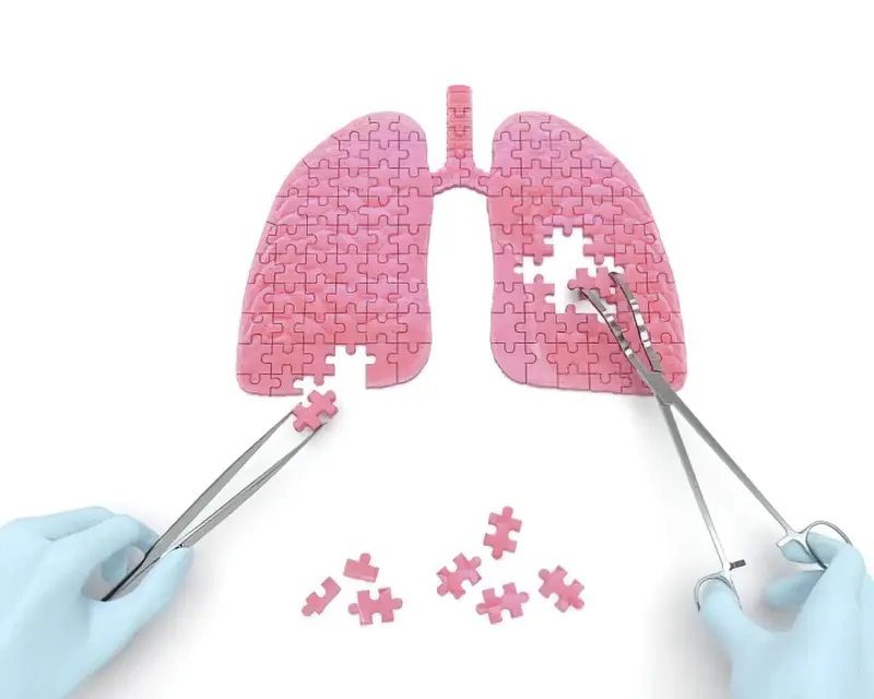 Туберкулема легень: симптоми, причини і методи лікування 2