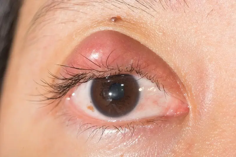 Запалені очі: як розпізнати, в чому причина і як лікувати 1
