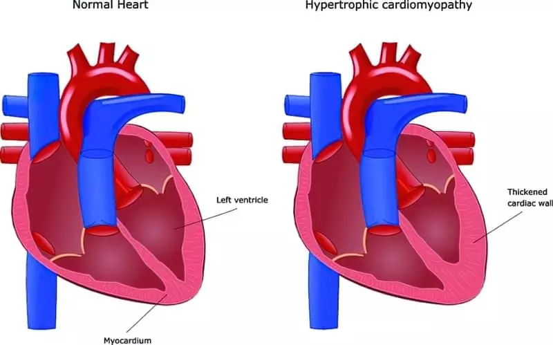 Гіпертрофічна кардіоміопатія: симптоми, діагностика, лікування 13