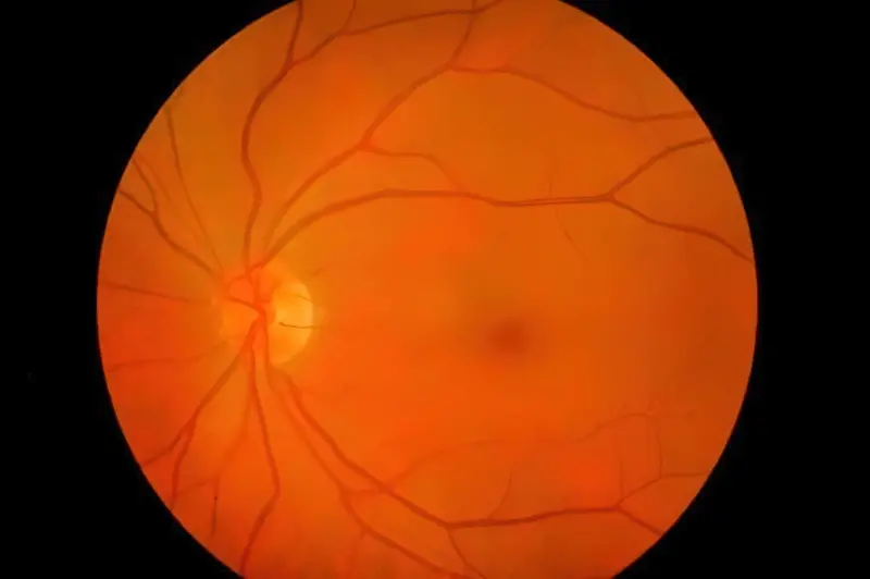 Периферична дегенерація сітківки ока: симптоми, діагностика та лікування 6