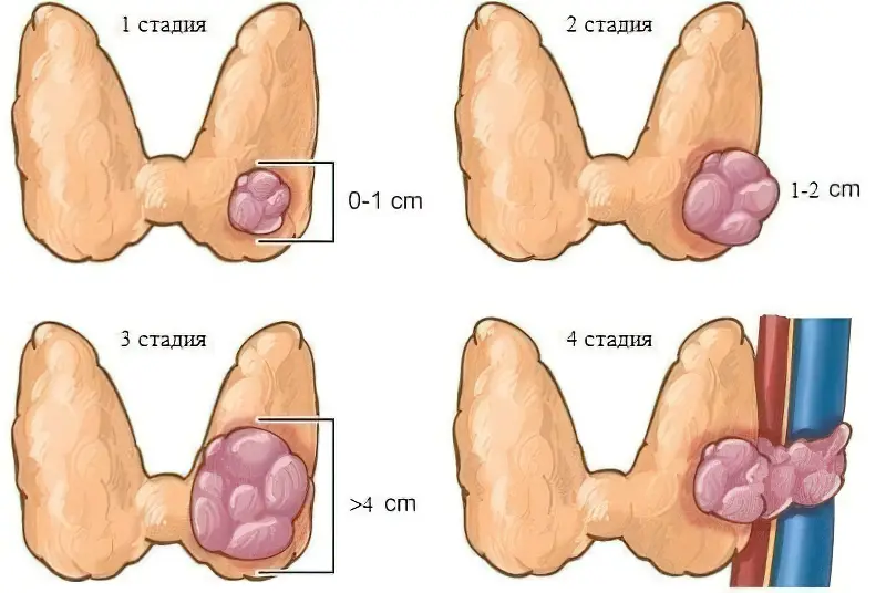 Стадії ракової пухлини щитовидки