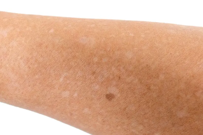 Білі плями на шкірі: причини, діагностика та можливі методи лікування 10