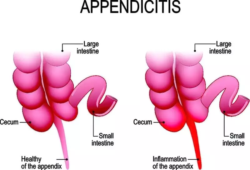 Симптоми апендициту: як відрізнити та вчасно розпізнати запалення 6