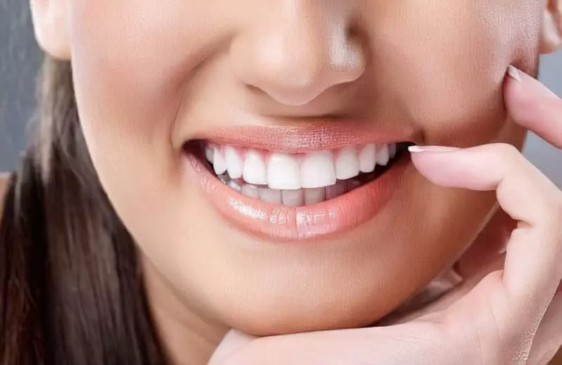Вініри: естетична стоматологія та усунення дефектів 5