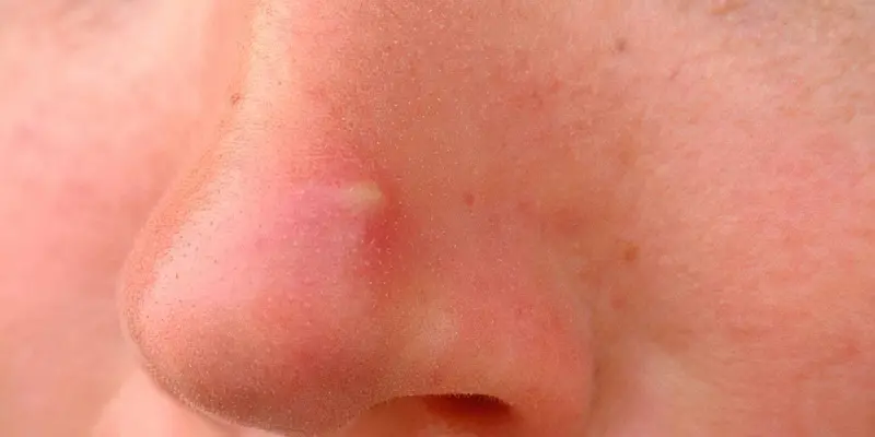 Фурункул носа: причини, симптоми і методи лікування 15