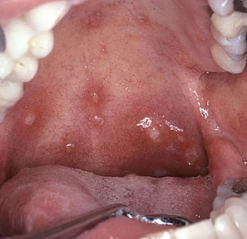 Пухирі в роті на слизовій: що це і до якого лікаря звертатися 2