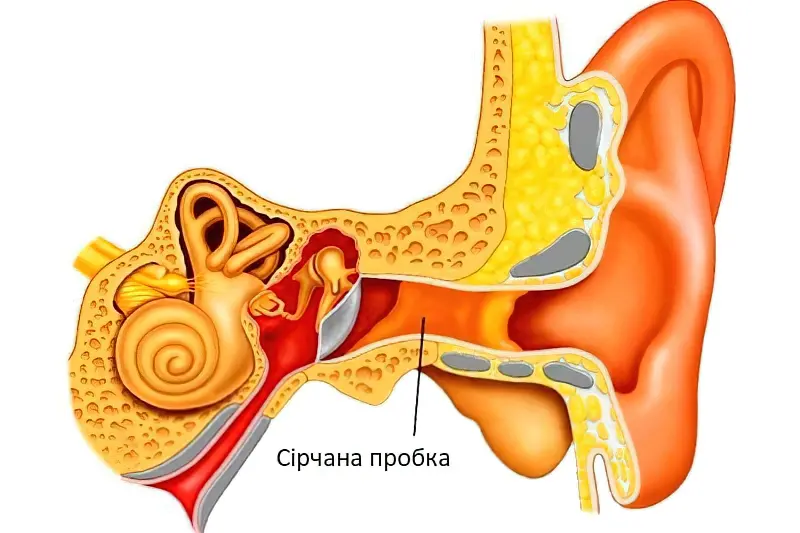 Як видалити сірчану пробку з вуха 2