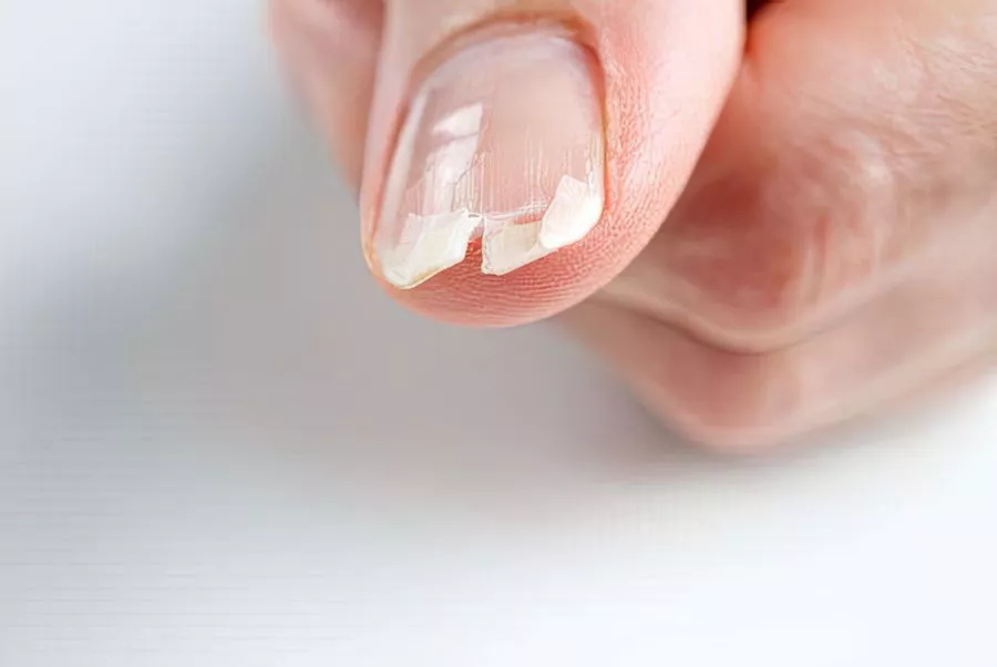 Ламкі нігті: причини, лікування та ефективні методи зміцнення 2