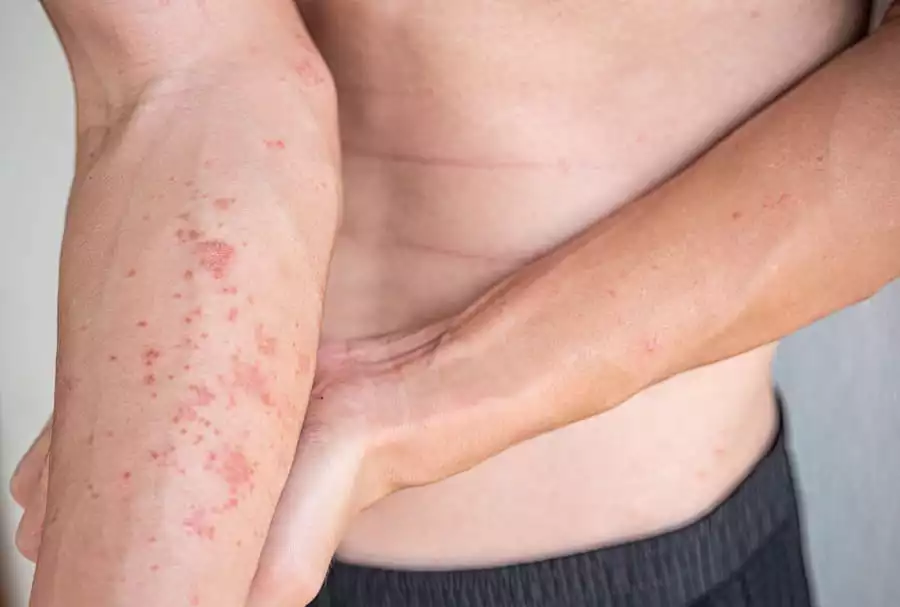 Атопічний дерматит: як подолати це хронічне захворювання шкіри 7