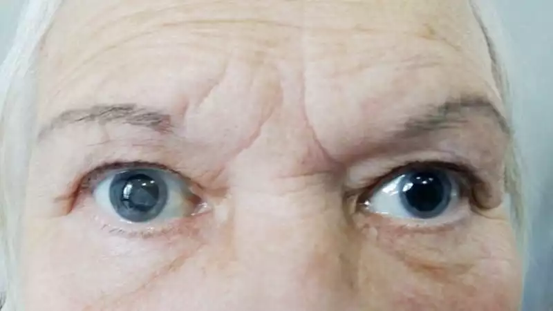 Причини виникнення та методи лікування катаракти 31
